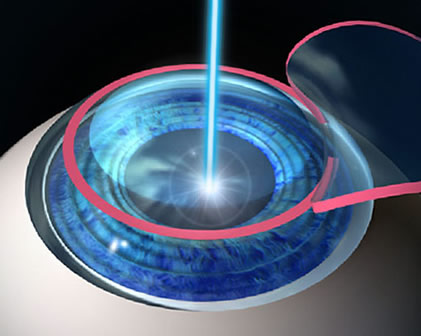 Cirurgia Refrativa a Laser para Miopia, Hipermetropia e Astigmatismo